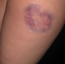 bruise