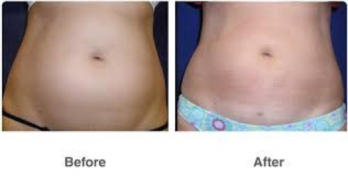 liposuction