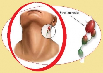 tonsillitis